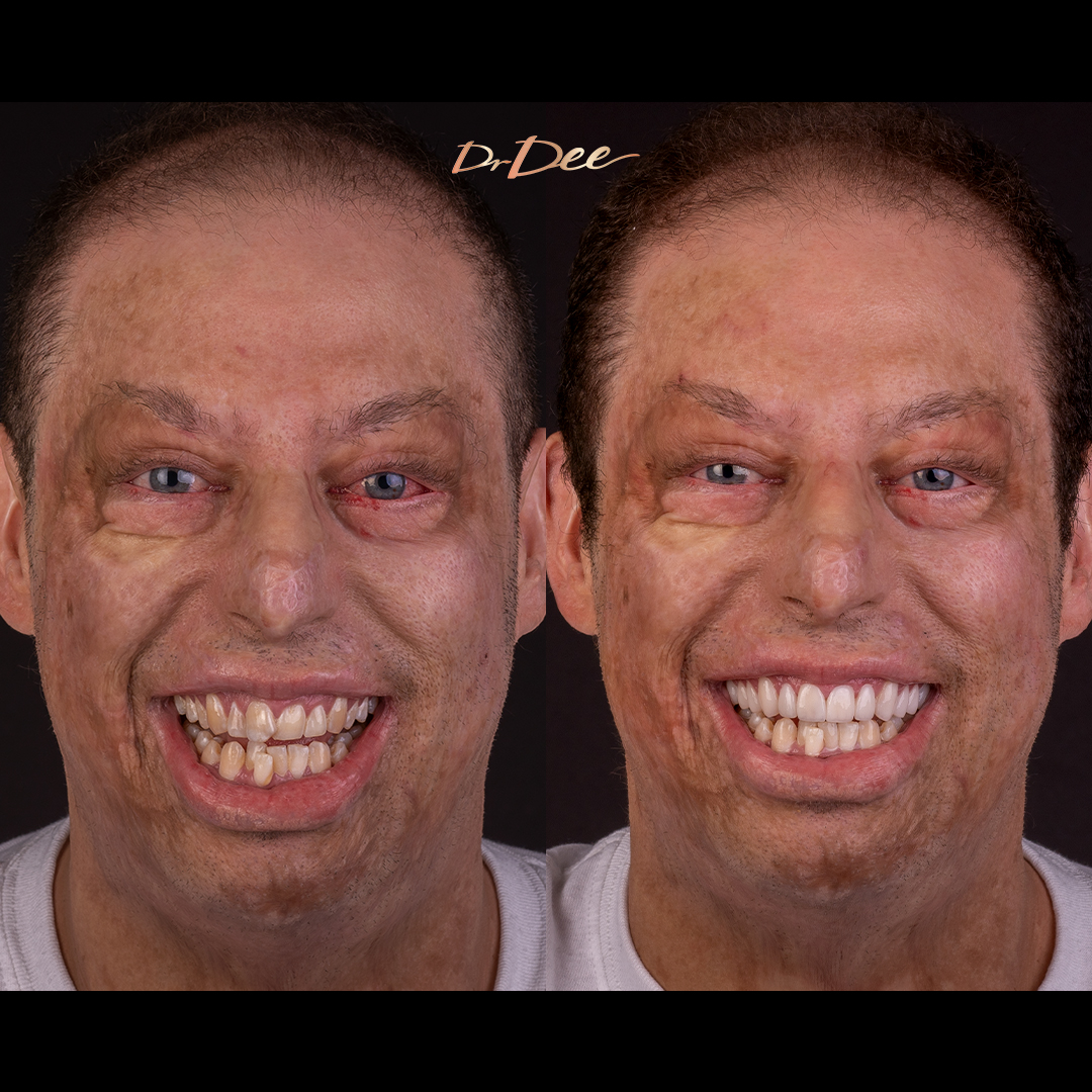 Christopher burn victim before and after smile makeover at Bring Back a Smile Foundation