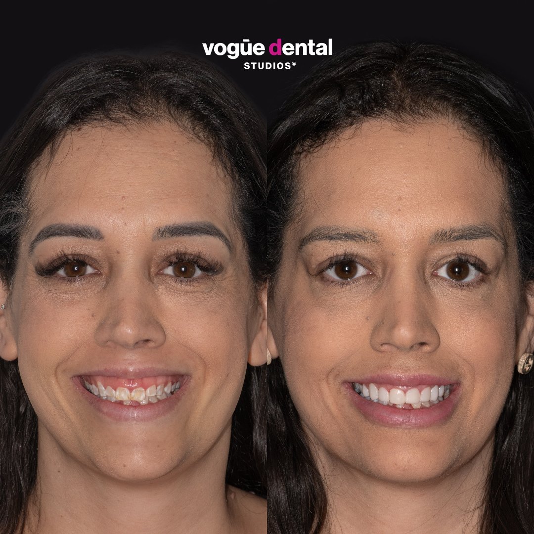 Paula gummy smile before and after at Bring Back a Smile Foundation
