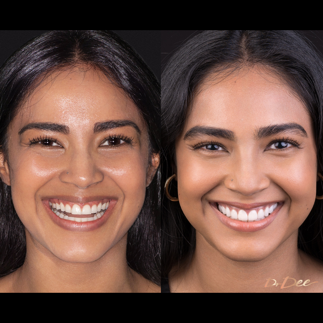 Before and after porcelain veneers smile makeover at Vogue Dental Studios - front face view Celina
