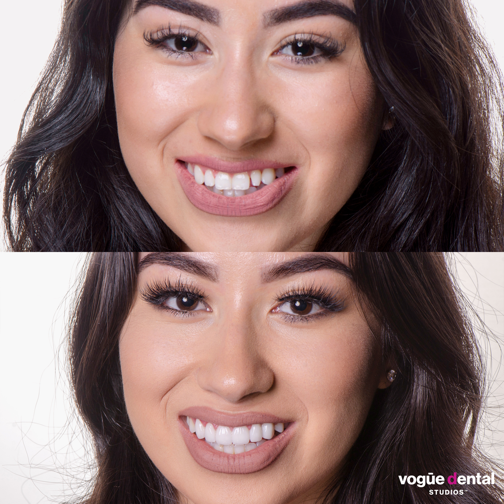 Before and after porcelain veneers at Vogue Dental Studios - Kristy