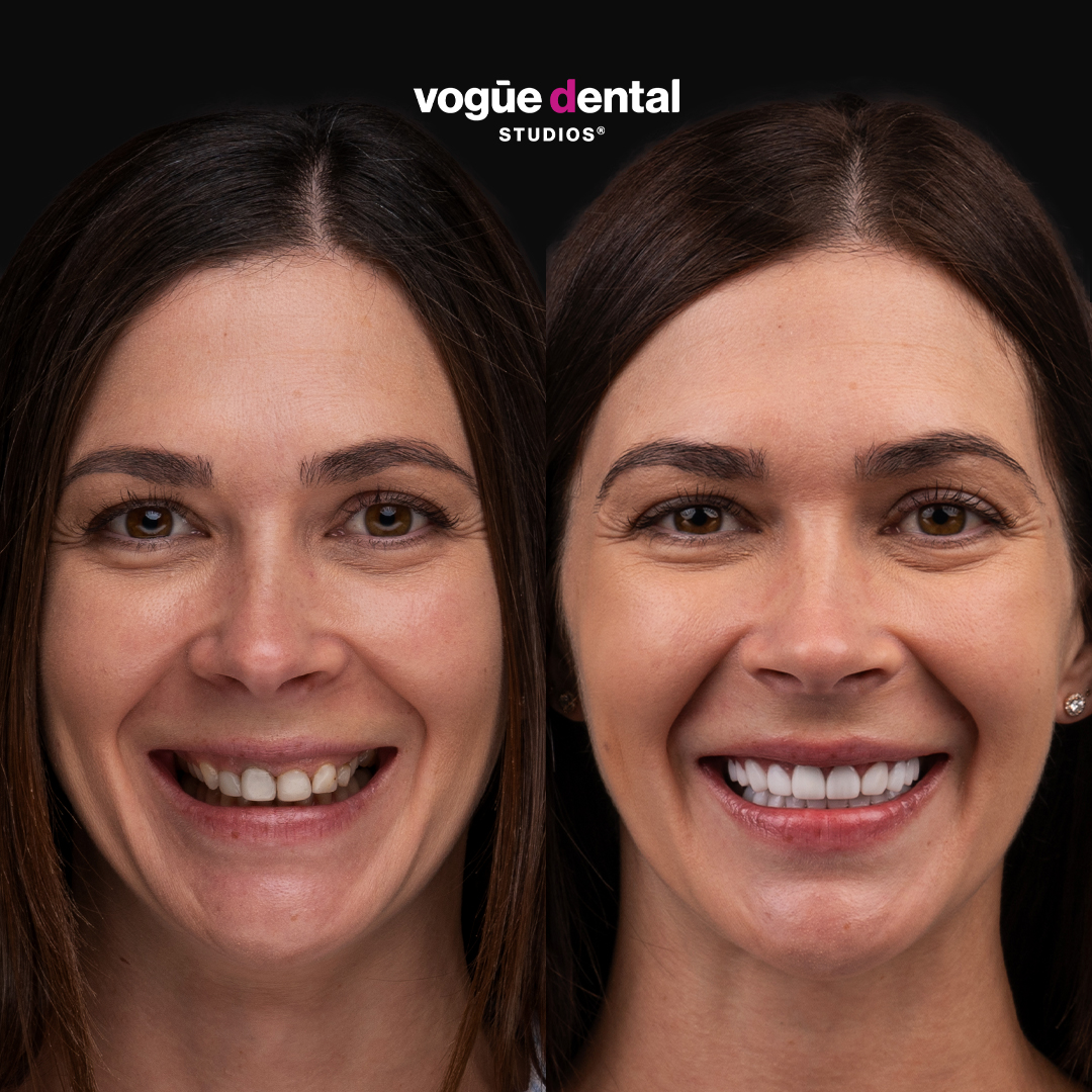 Before and after porcelain veneers at Vogue Dental Studios - Front View Bethany 