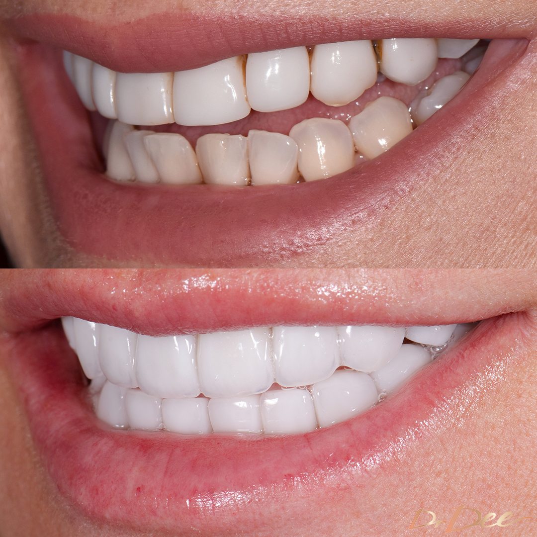 Mary Kalifatidis before and after Picasso Porcelain Veneers