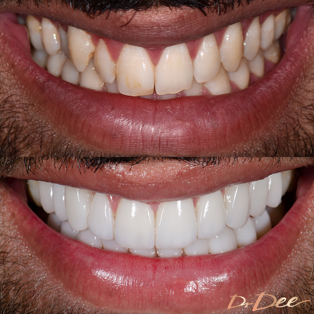 Ibrahim Akbar before and after porcelain veneers front teeth view.