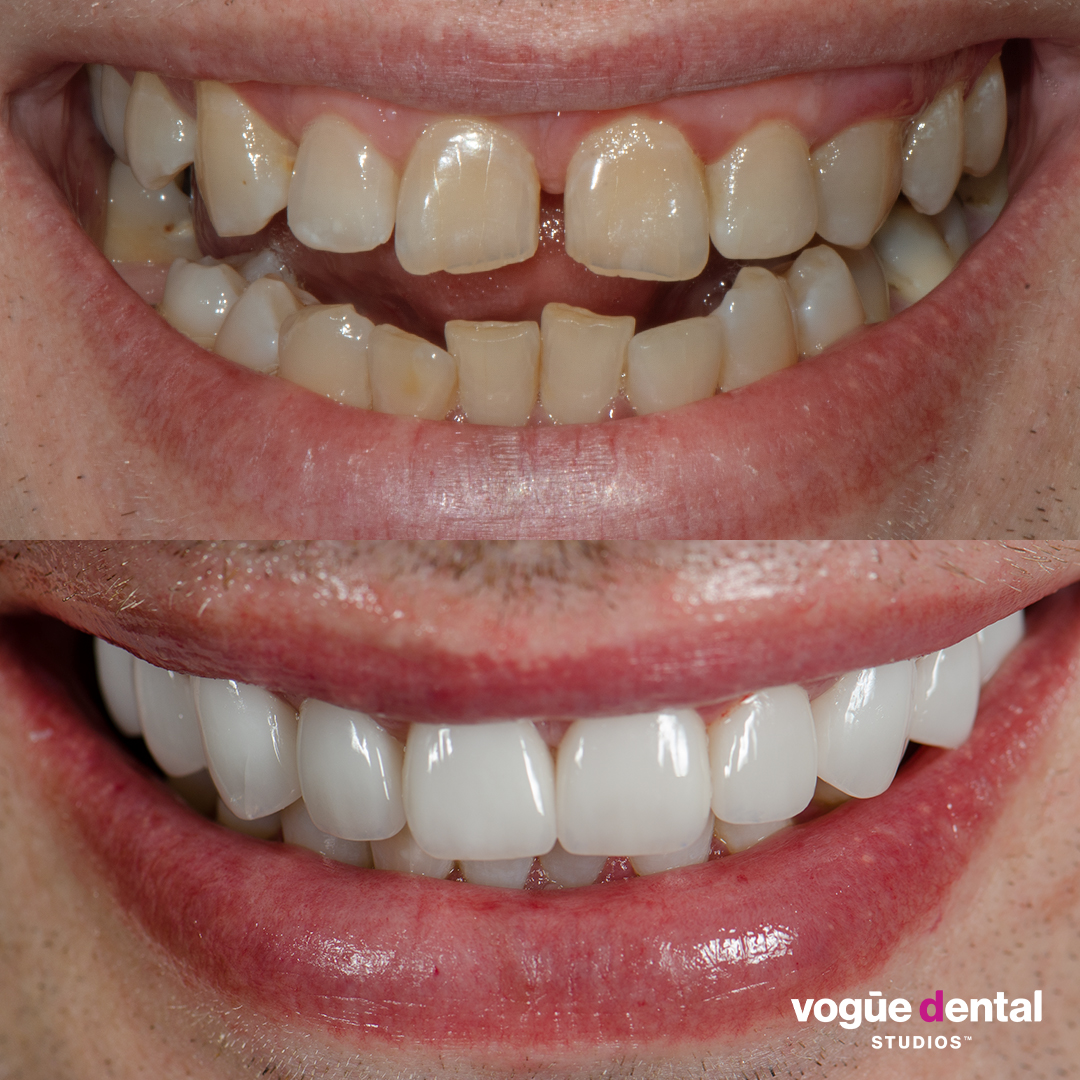 Before unwanted spacing and after porcelain veneers at Vogue Dental Studios - teeth view Heath