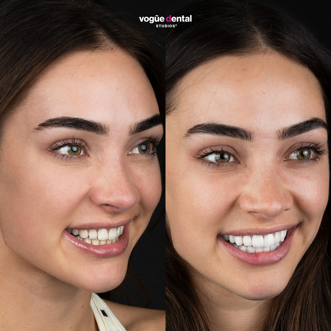Before and after porcelain veneers at Vogue Dental Studios - right teeth view Monique