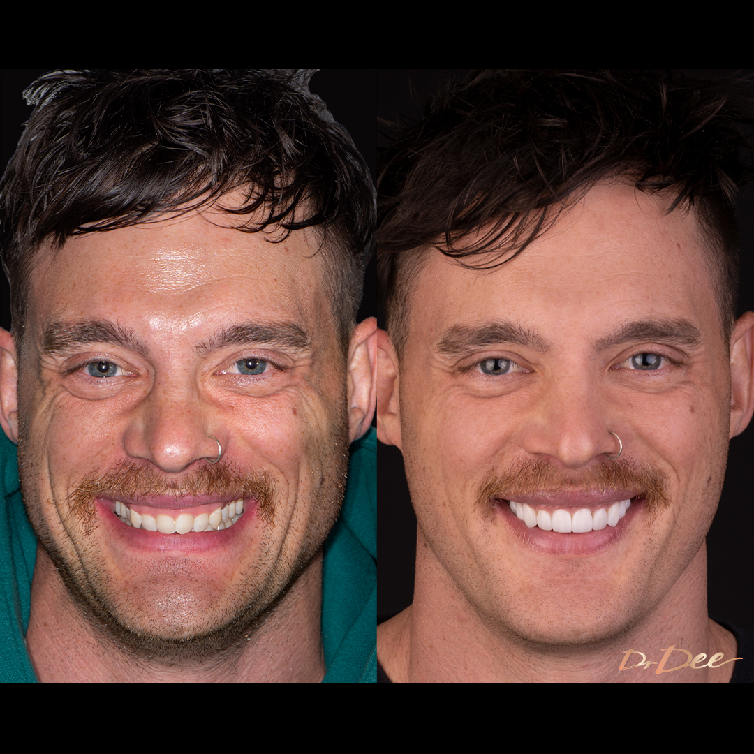 Before and after veneers for gummy smile Jackson Lonie - front face view