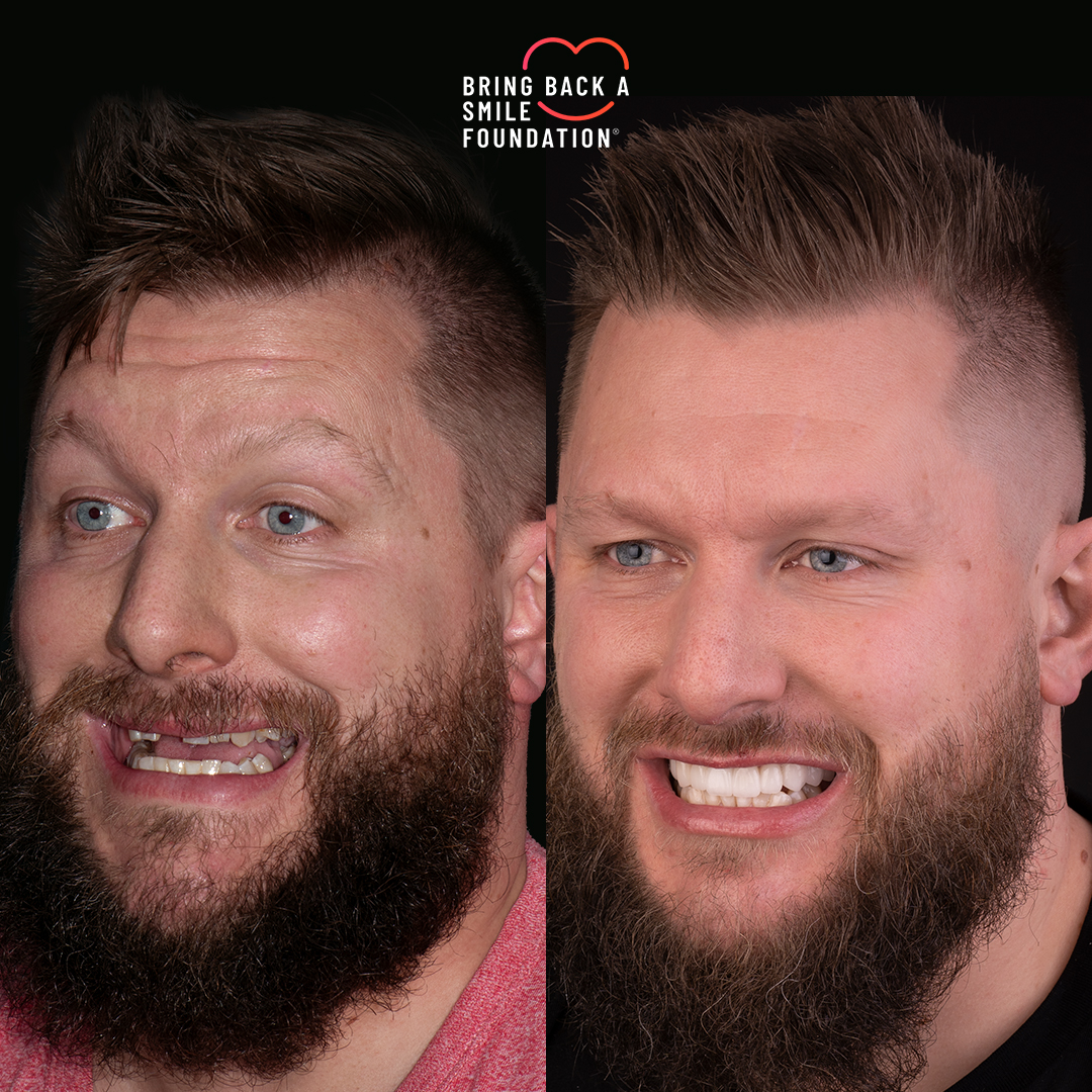 Craig missing front tooth before after smile makeover at Bring Back a Smile Foundation