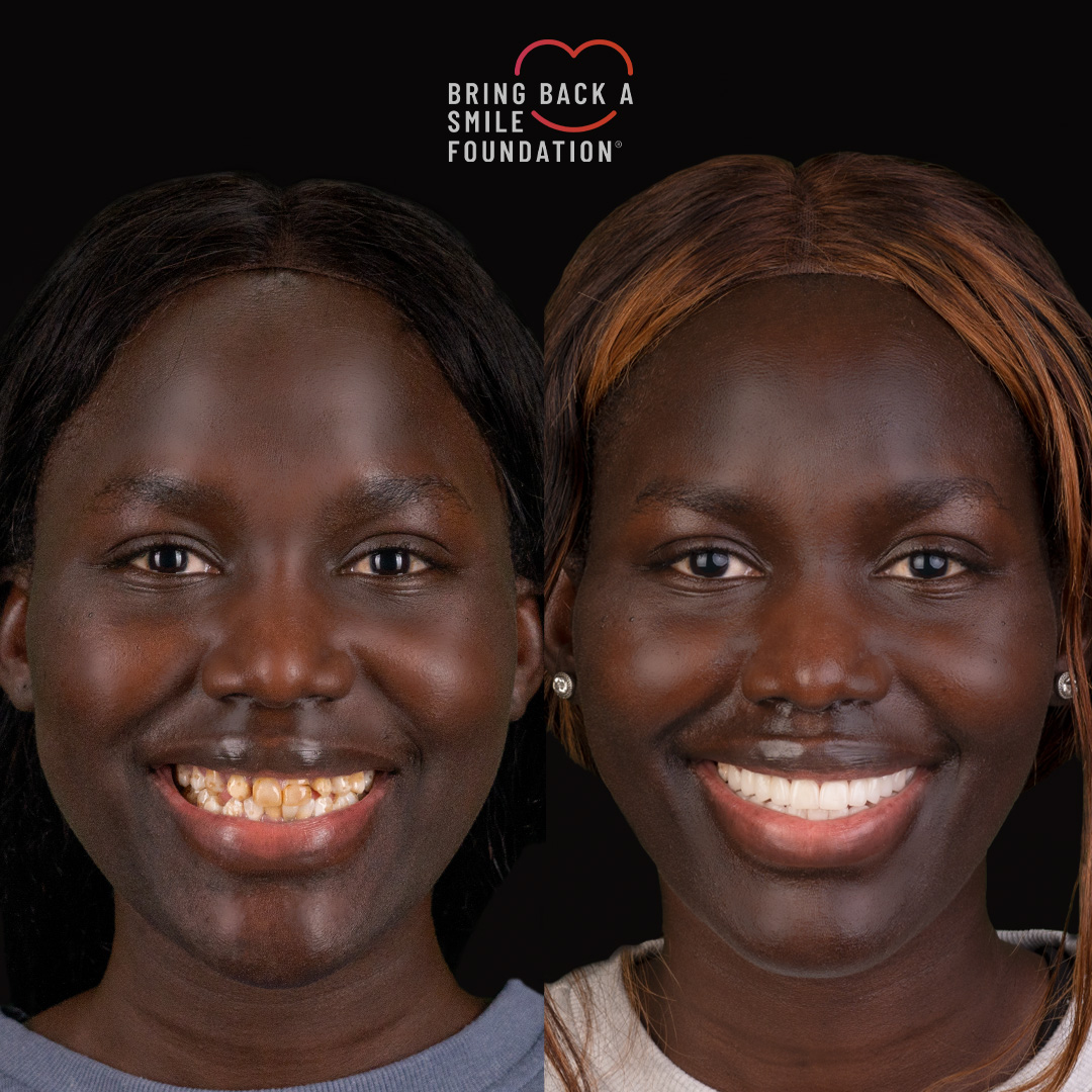 Isara a Bring Back a Smile Foundation receiver before and after dramatic smile makeover full face