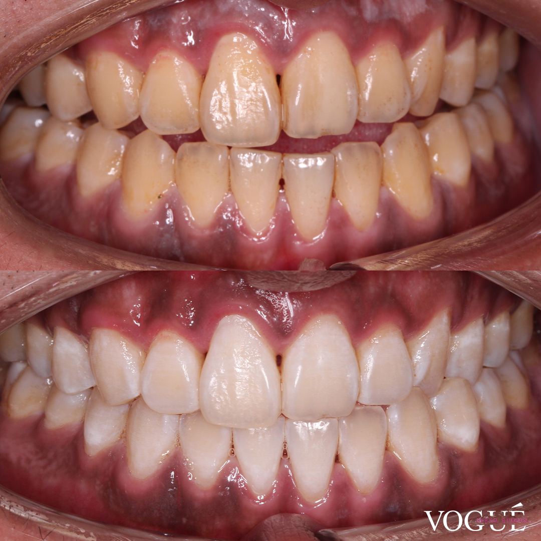 Before and after in-chair teeth whitening at Vogue Dental Studios - prior severe staining.