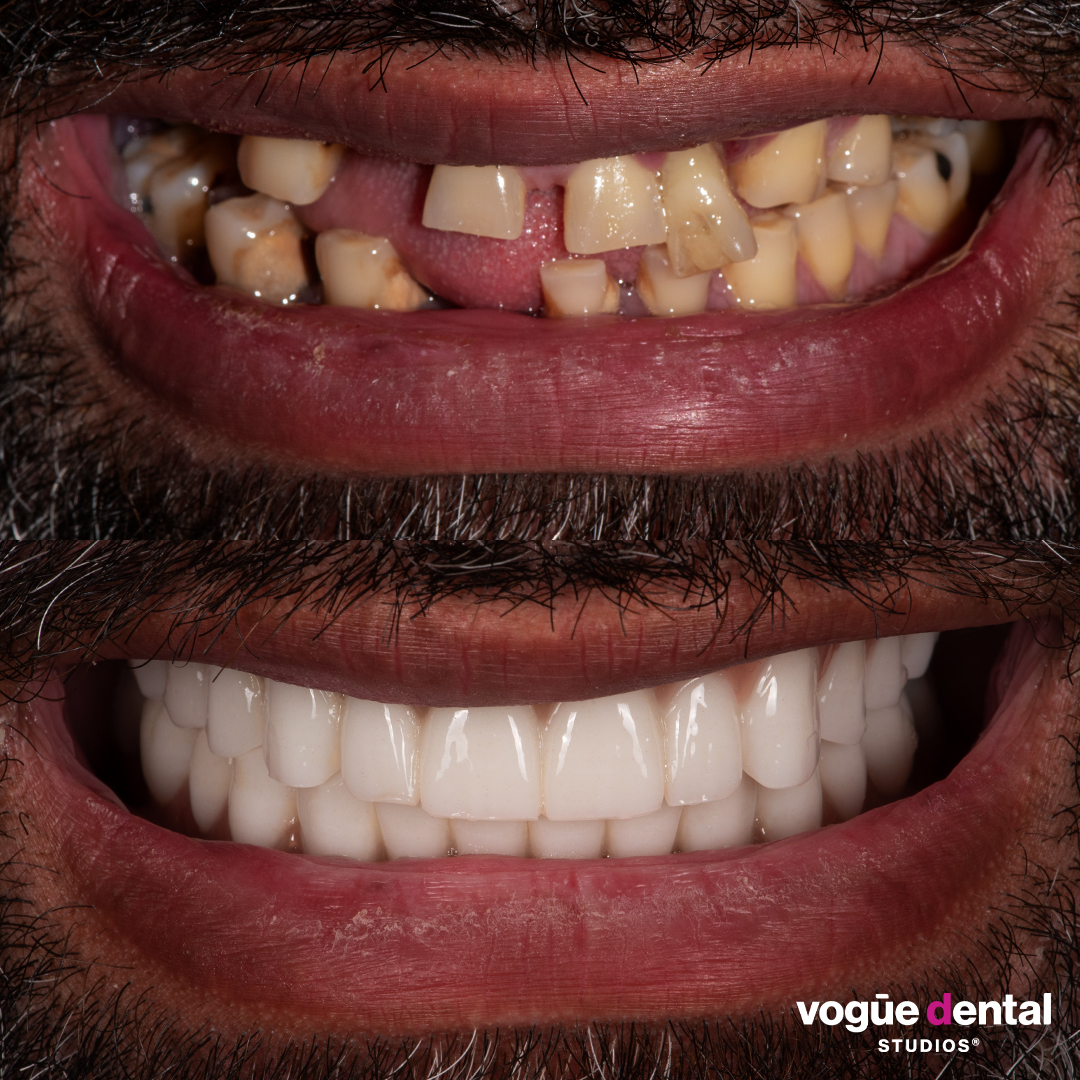 Before and after implant smile makeover at Vogue Dental Studios - front view Sione