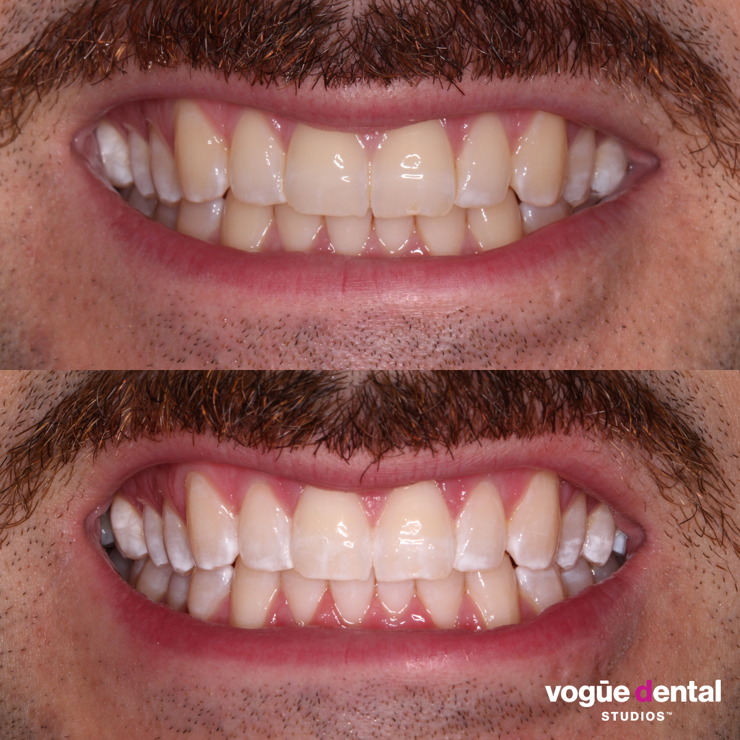 Before and after in-chair teeth whitening at Vogue Dental Studios - front teeth view Jamie.