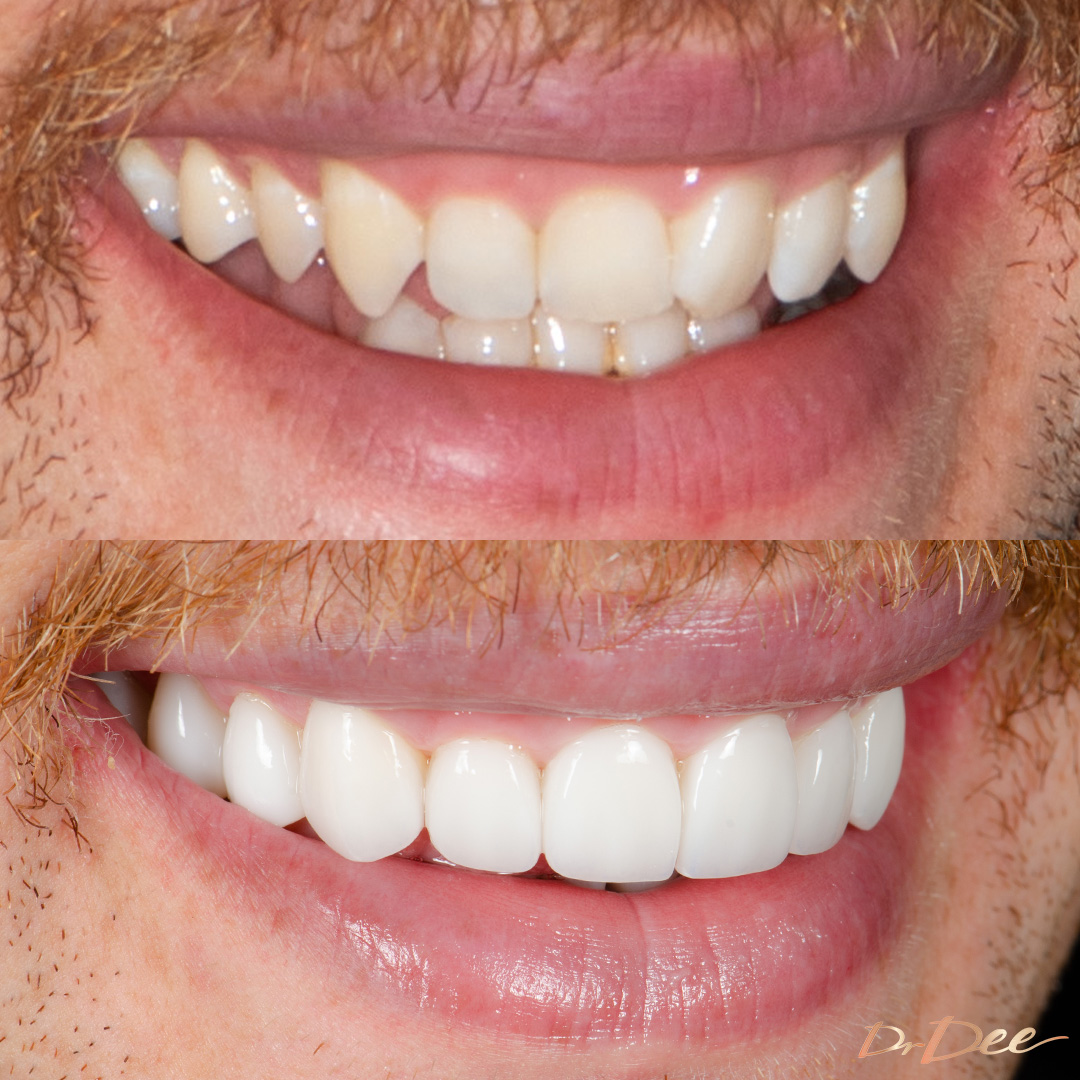 Before and after veneers for gummy smile Jackson Lonie - right teeth view