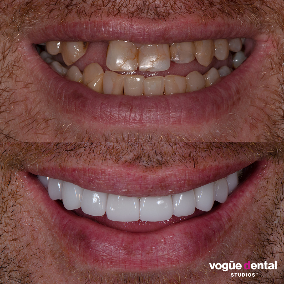 Before and after missing teeth with porcelain veneers at Vogue Dental Studios - front teeth view Con