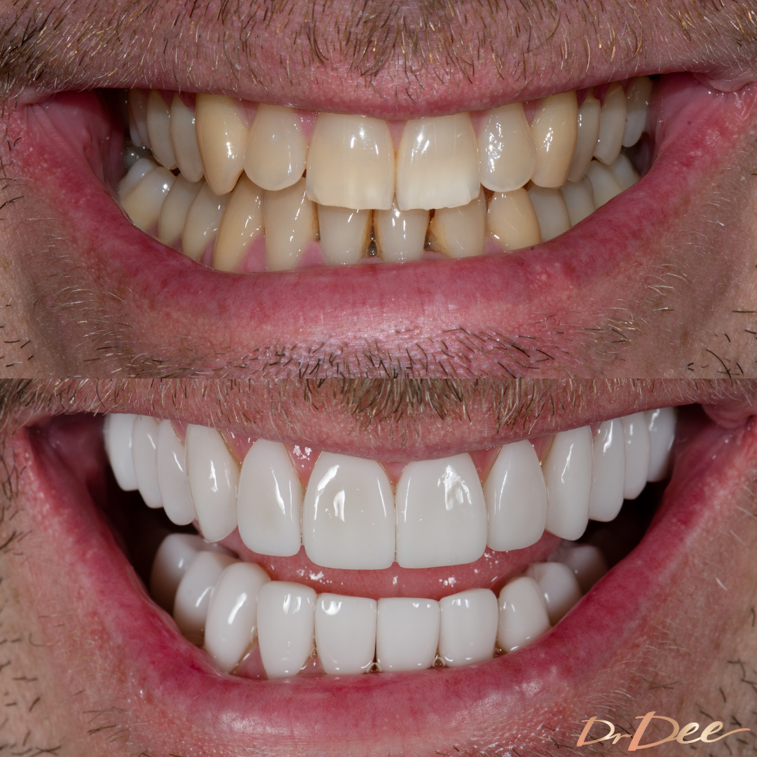 Before and after veneers for staining Matt Ridley - front smile view