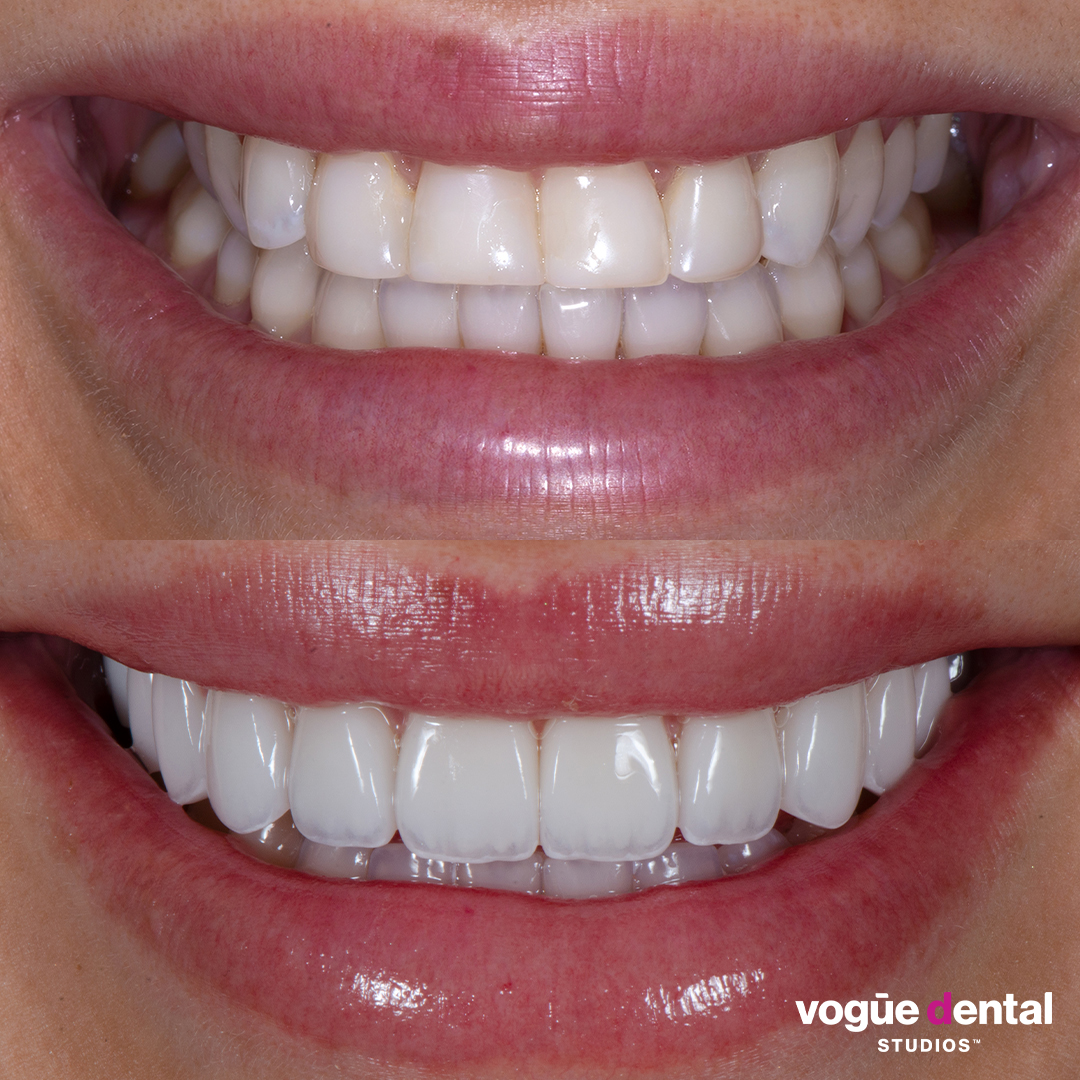 Kayla Itsines before and after porcelain veneer smile makeover front teeth view.