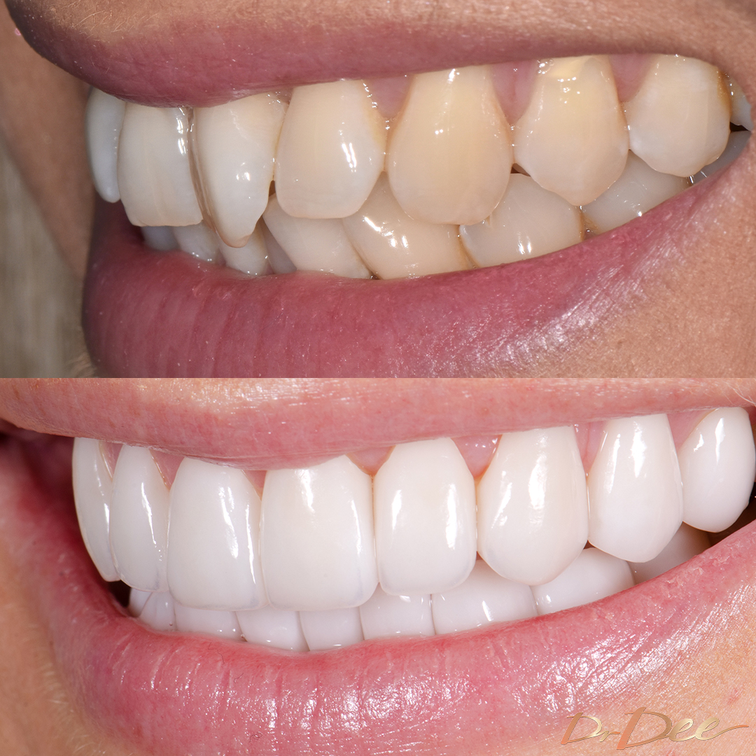 Joanne Todd from MAFS before and after smile makeover of butterfly teeth.