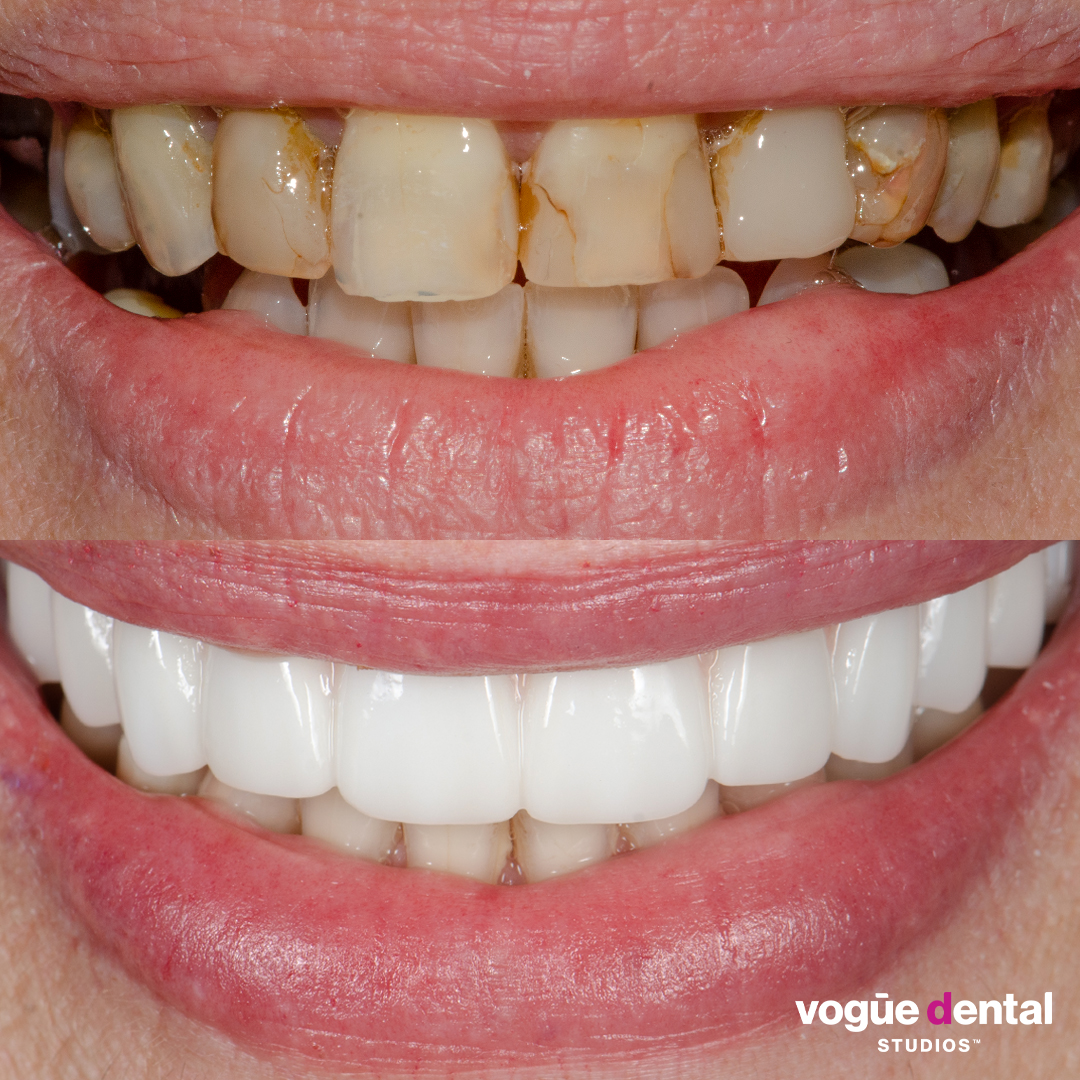 Before and after implant smile makeover at Vogue Dental Studios - front teeth view Santina