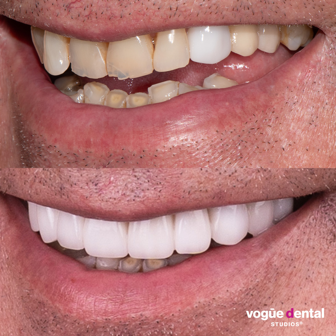 Before and after porcelain veneers and implant smile makeover at Vogue Dental Studios - front teeth view Tom