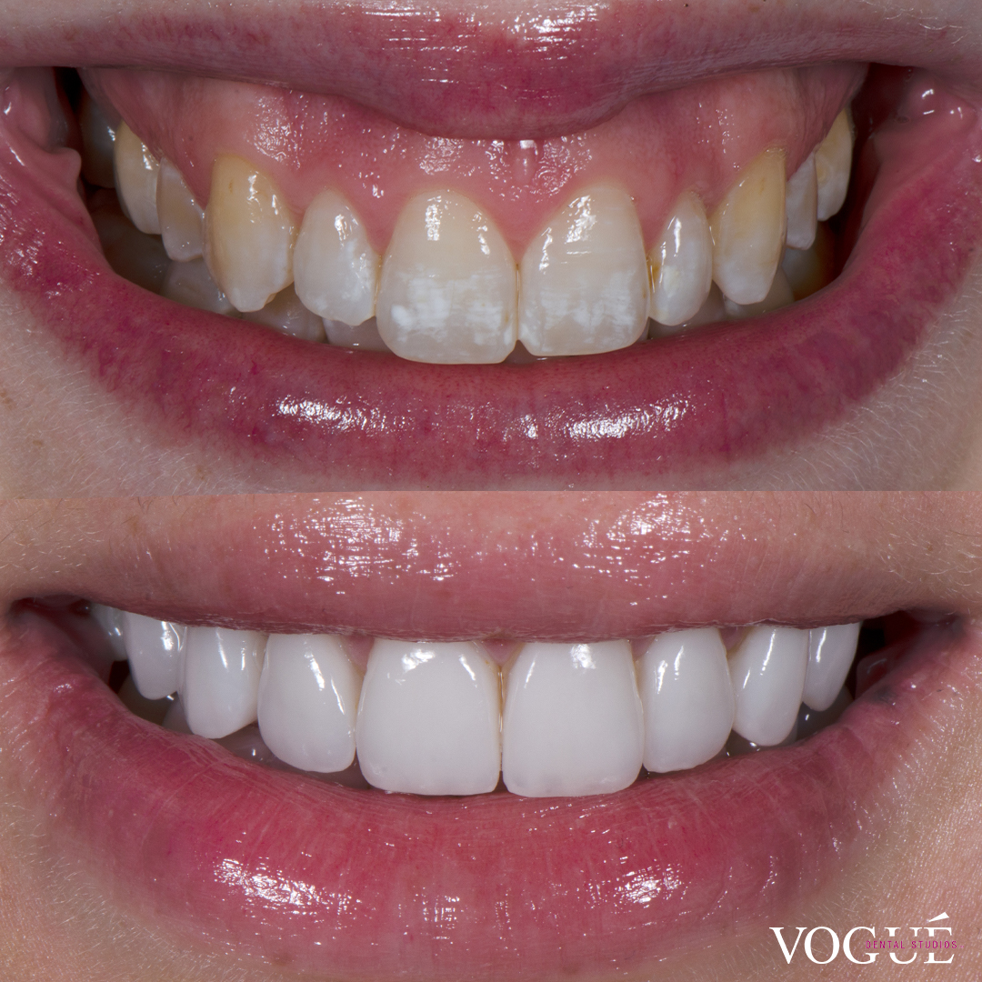 Gum Laser Surgery Vogue Dental Studios