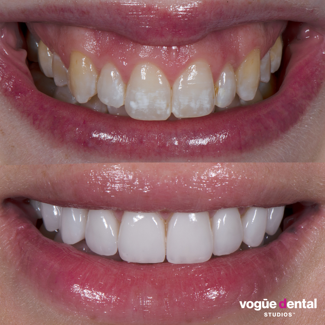 Before and after gummy smile with porcelain veneers at Vogue Dental Studios - front teeth view Christina.
