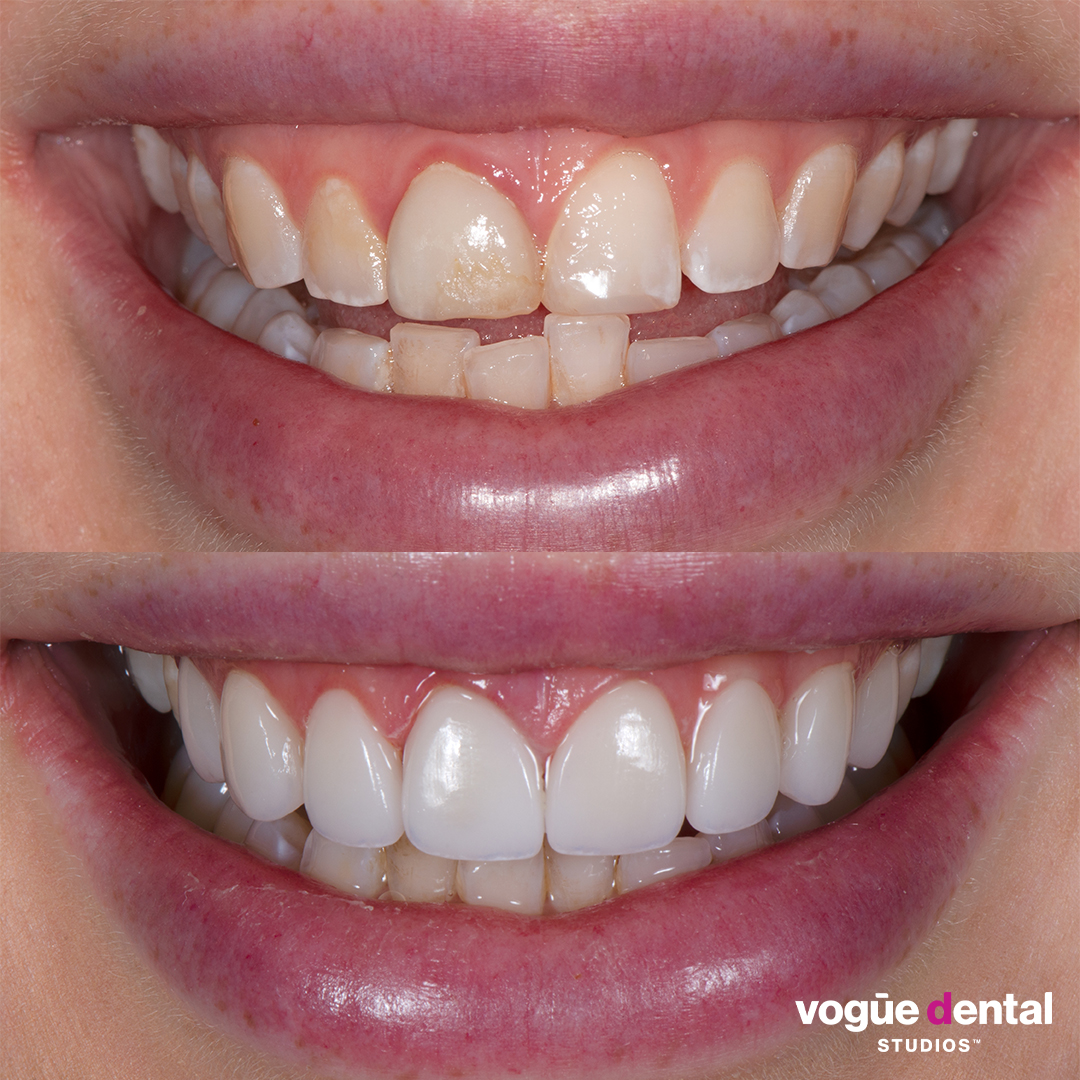 Before and after porcelain veneers at Vogue Dental Studios - front teeth view Rebecca
