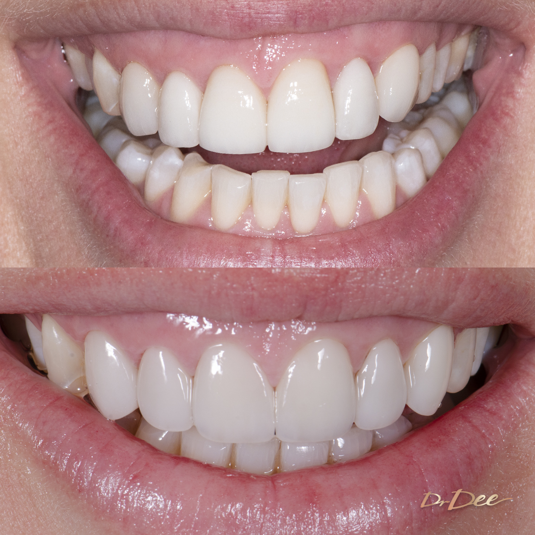 Before and after with porcelain veneers at Vogue Dental Studios - front teeth view Clare