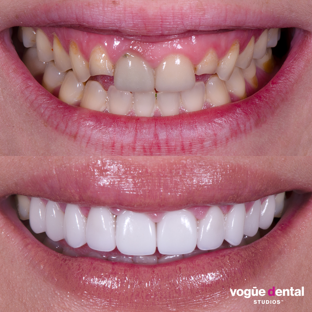 Before and after small teeth with porcelain veneers at Vogue Dental Studios - front teeth view Renee.