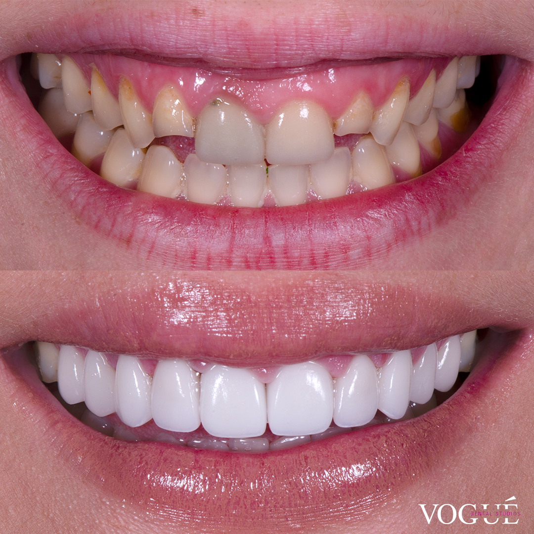 Porcelain Veneers and Smile Makeovers Vogue Dental Studios
