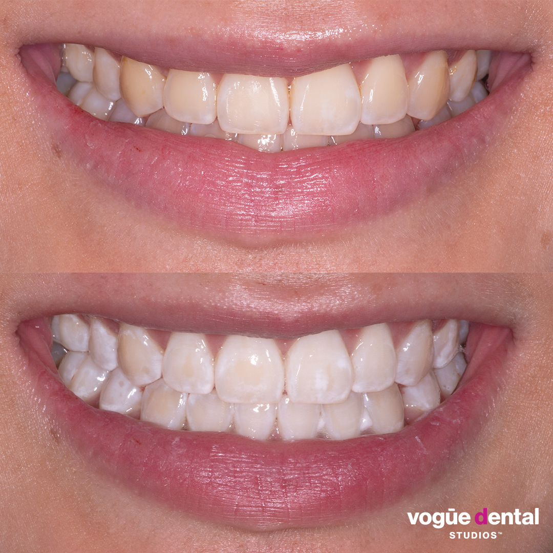 Before and after in-chair teeth whitening at Vogue Dental Studios - Joanne front smile view.