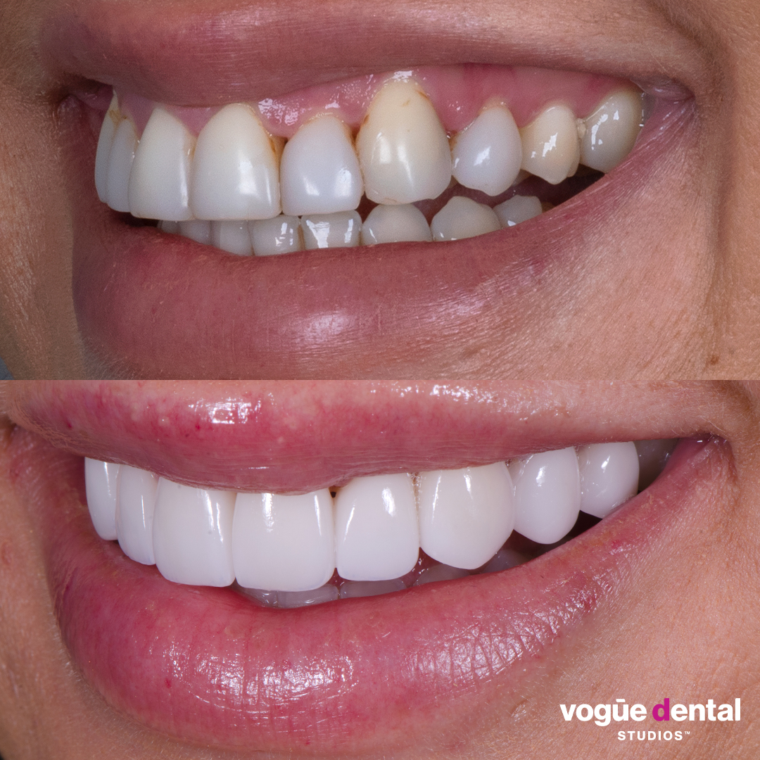 Before and after porcelain veneers at Vogue Dental Studios - Left Side View Jessica Brody The Bachelor