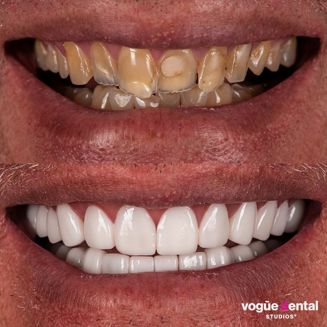 Zoran smile makeover with porcelain veneers at Vogue Dental Studios front teeth view