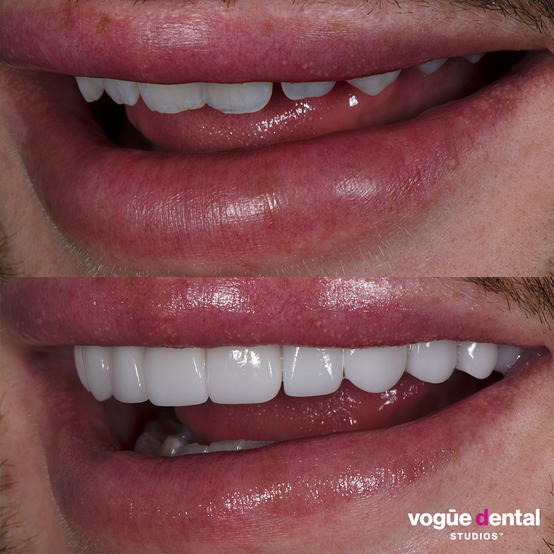 Michael Finch makeup artist before and after porcelain veneers at Vogue Dental Studios left teeth view.