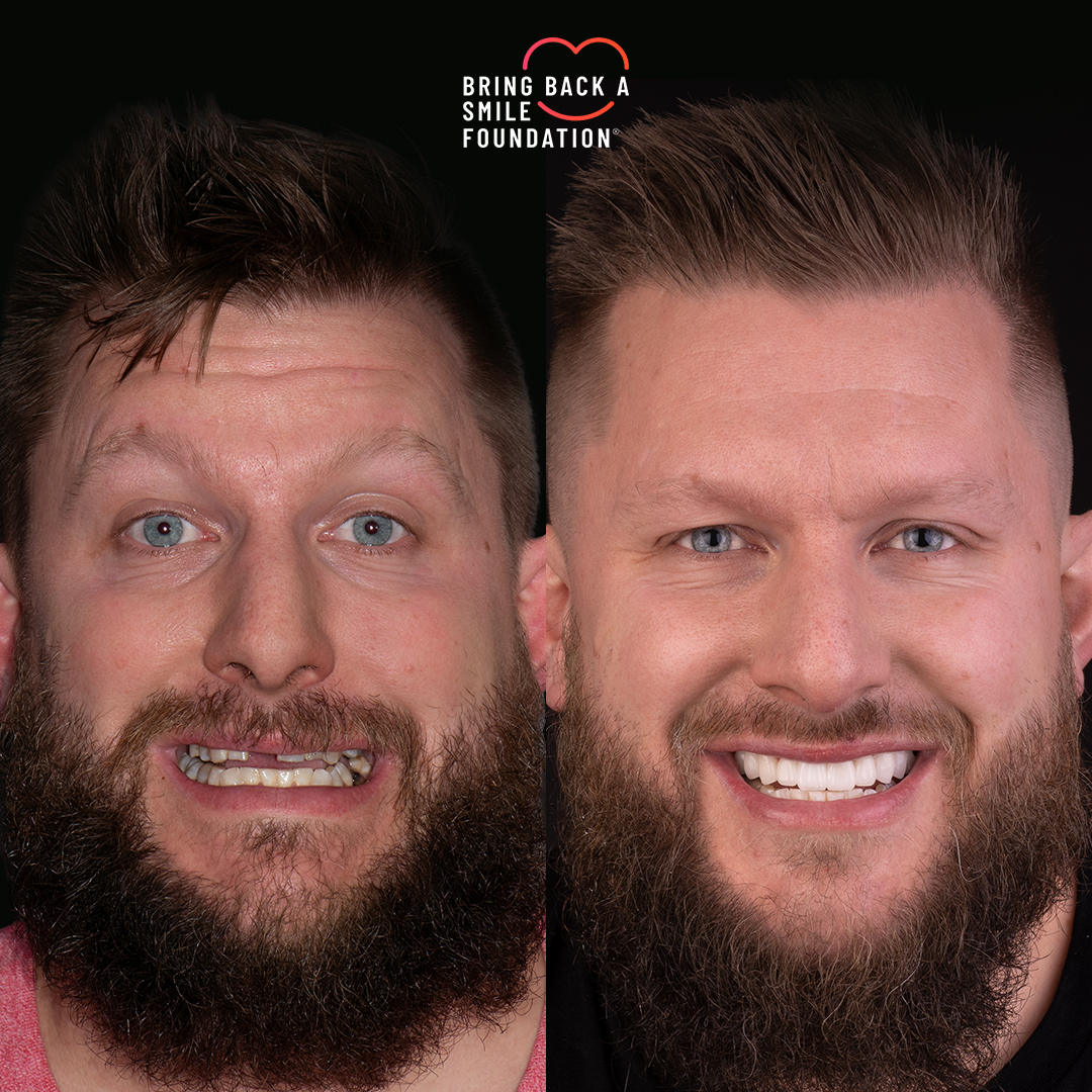 Craig missing front tooth before after smile makeover at Bring Back a Smile Foundation