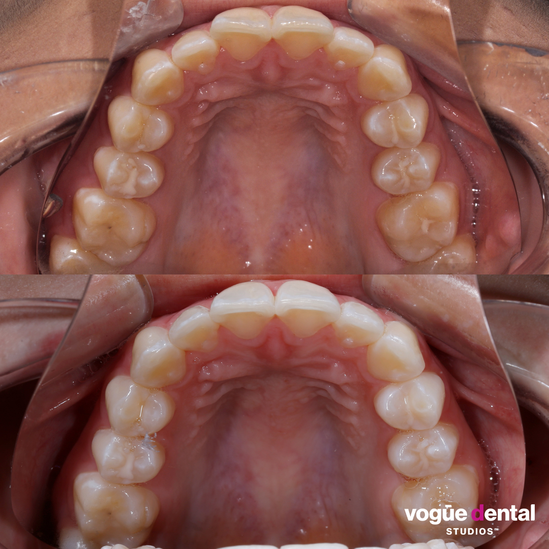 Before and After Invisalign i7 and whitening at Vogue Dental Studios - front teeth view Vee.