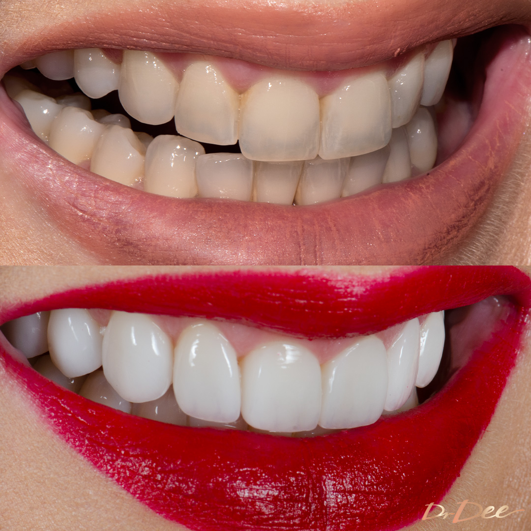 Before and after porcelain veneers Rachael De Olivera - right smile view