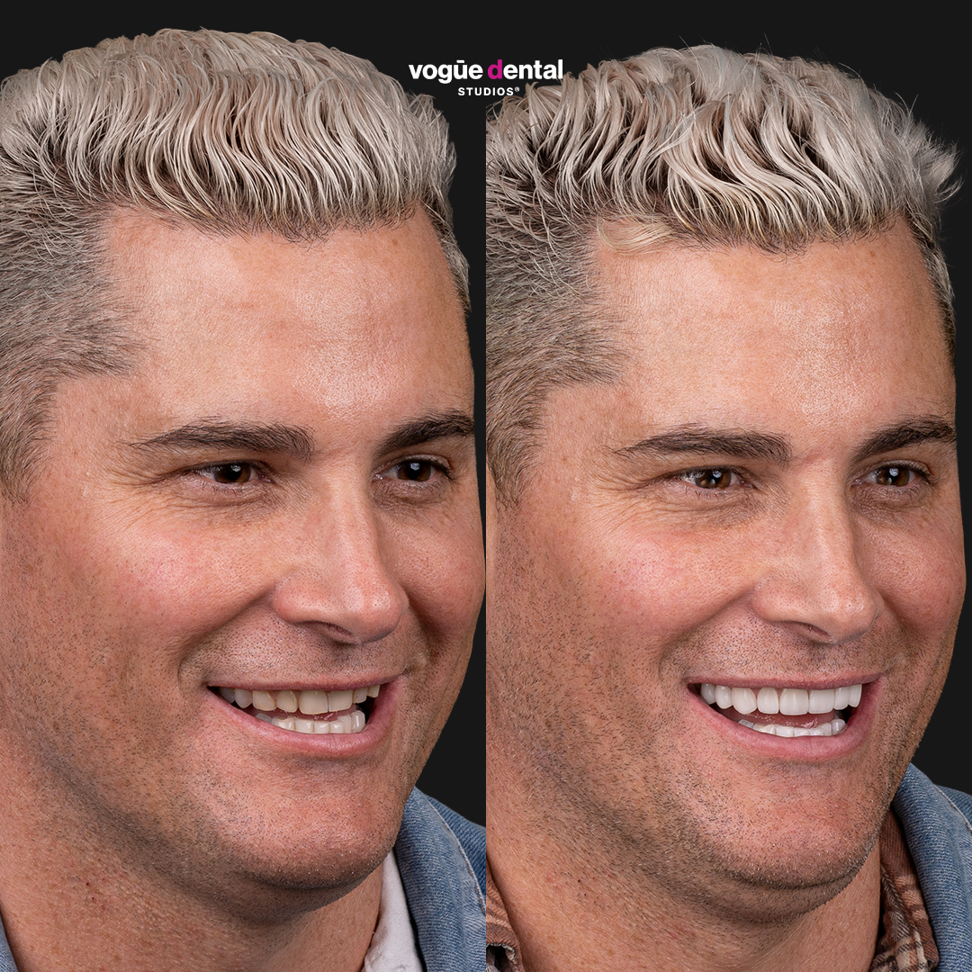 Jamie Doran smile makeover with porcelain veneers at Vogue Dental Studios