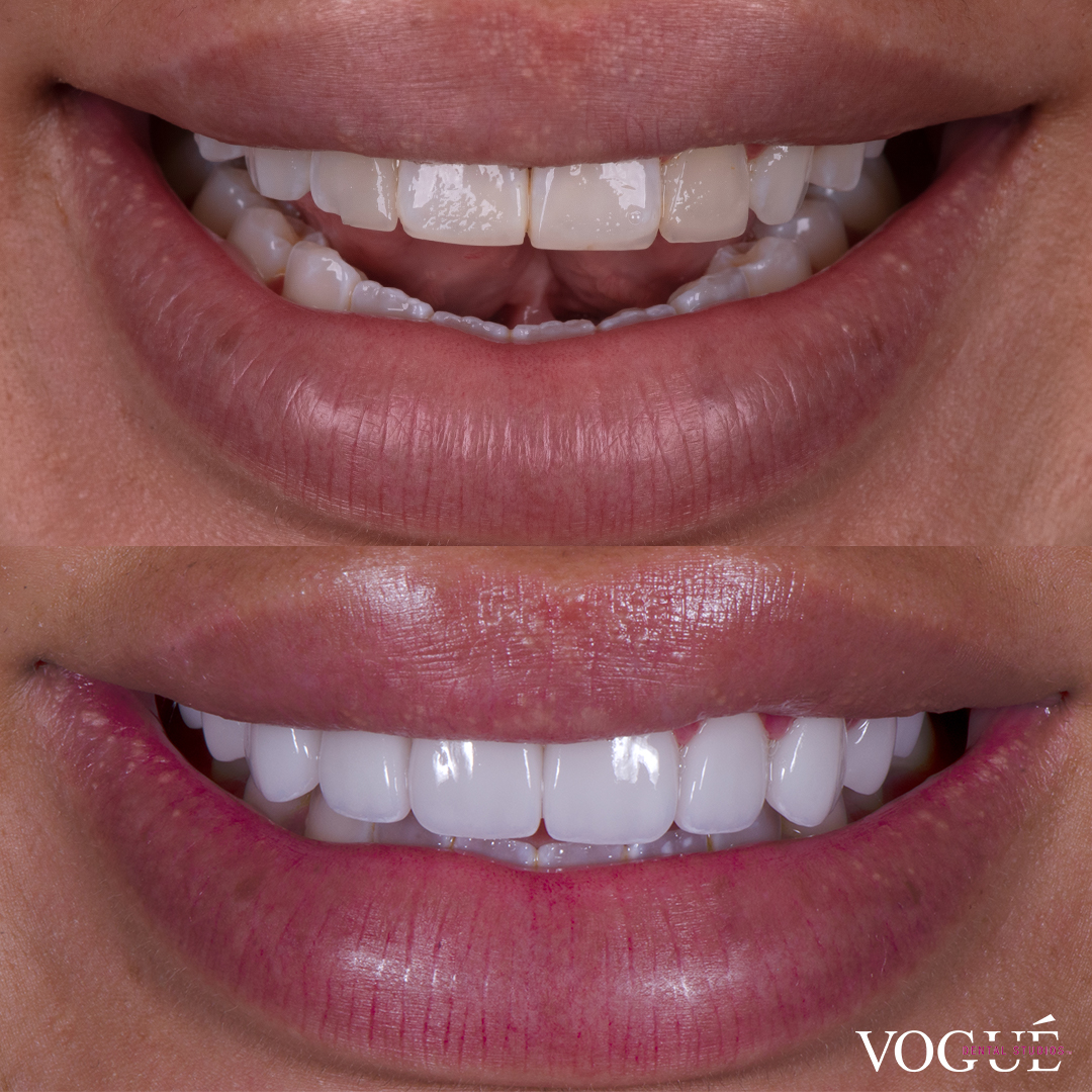 Miss Zedd revision veneers at Vogue Dental Studios before and after front view.