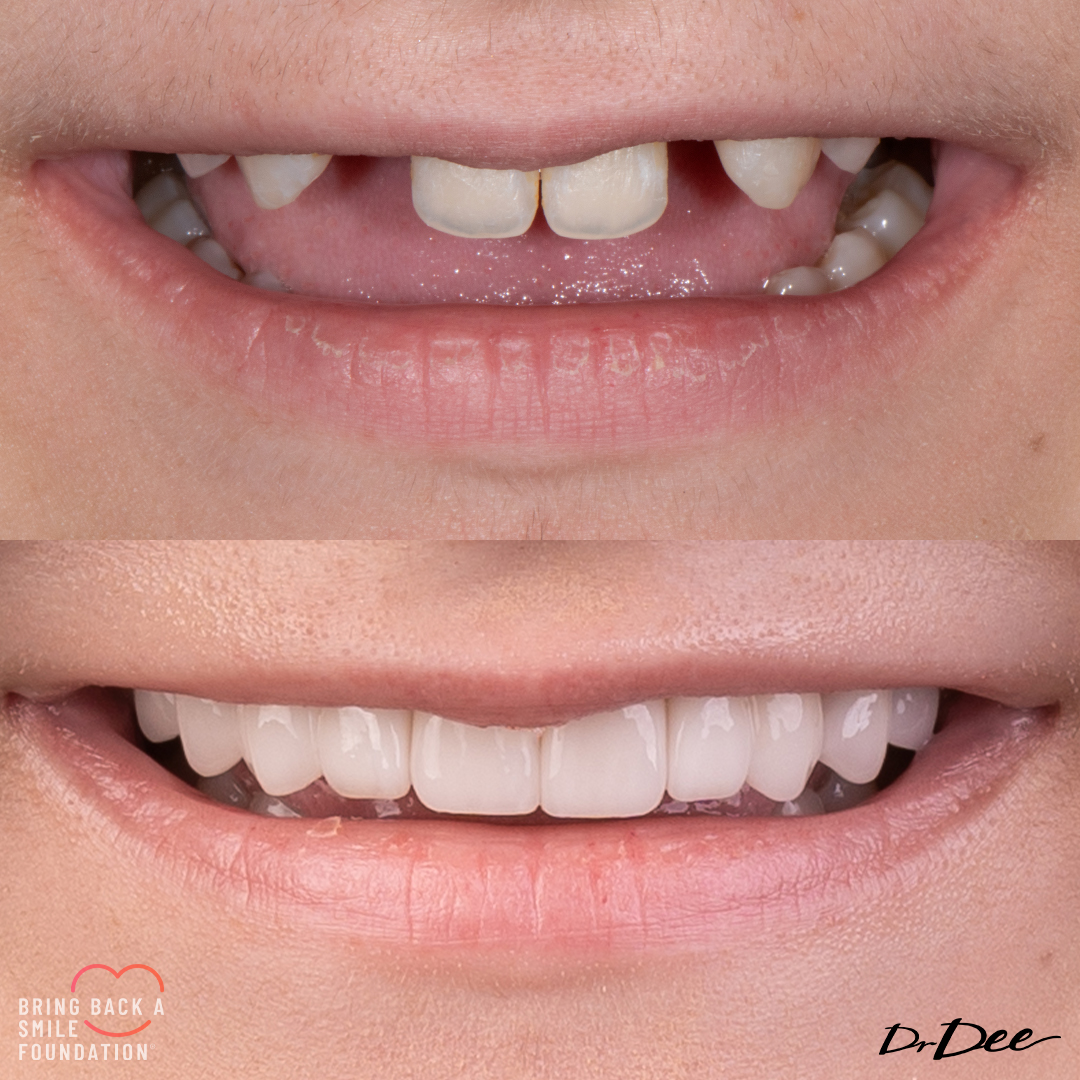 Bring back a smile foundation before and after veneers missing laterals