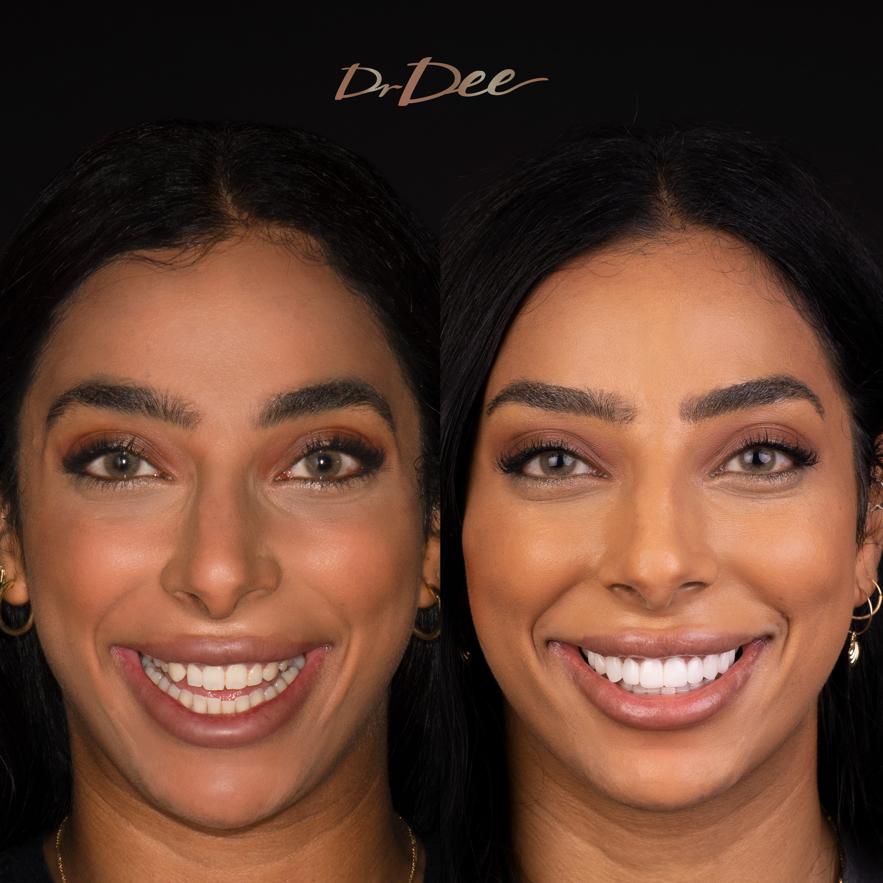 Before and after small teeth with porcelain veneers at Vogue Dental Studios - Marie Face