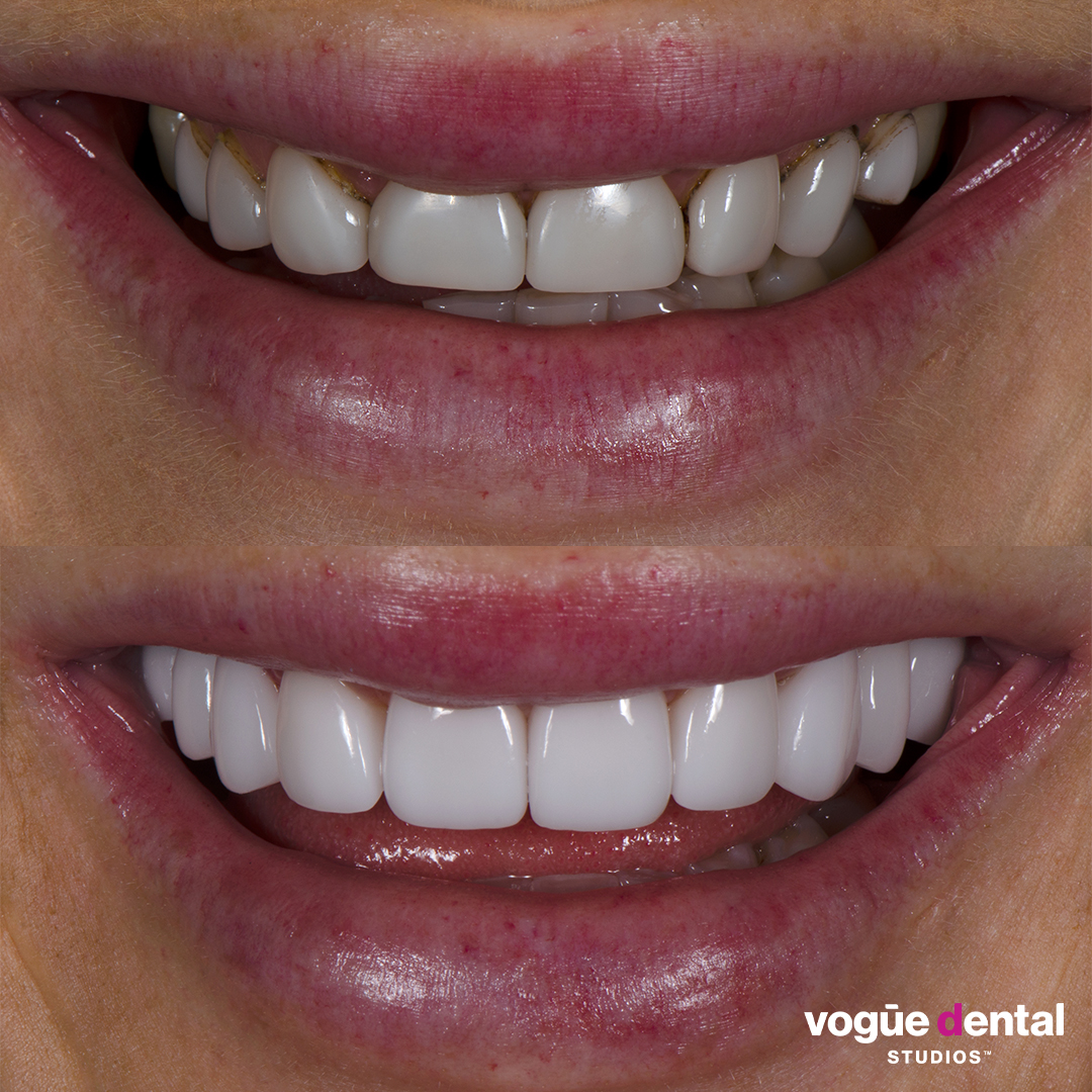 Before and after porcelain veneers smile makeover at Vogue Dental Studios - front teeth view Ines.