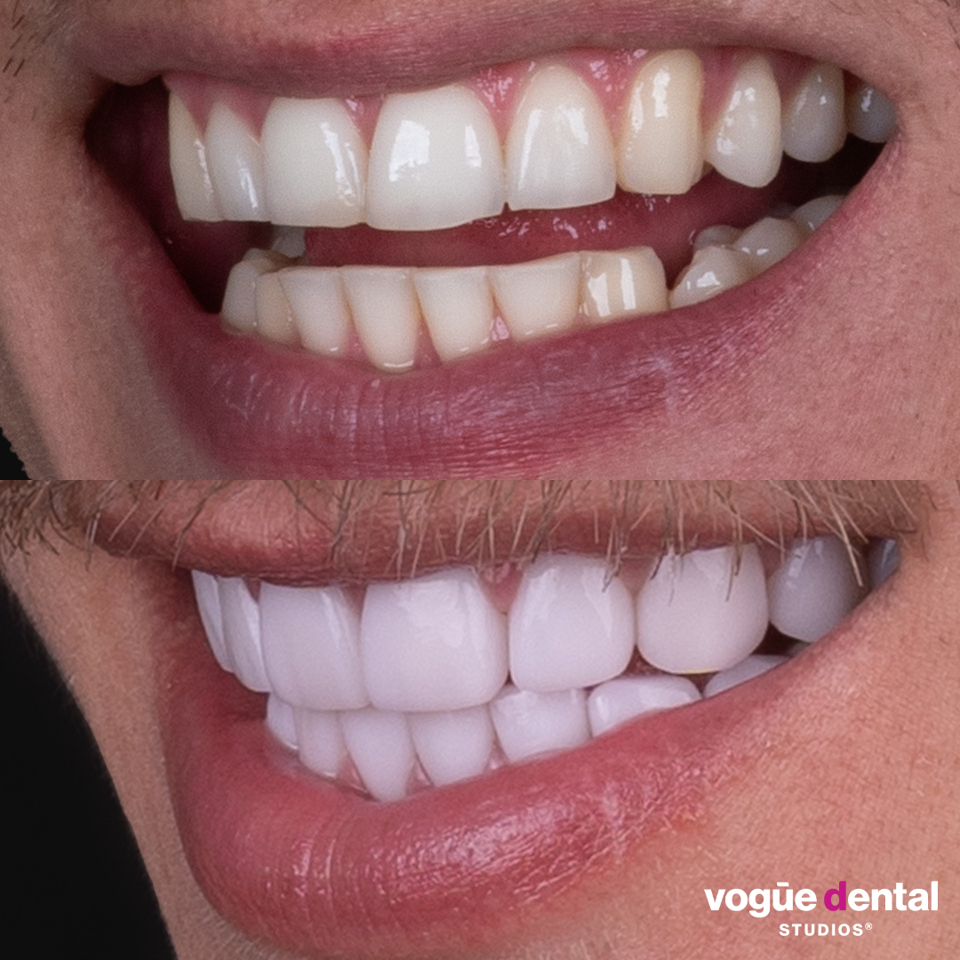 Ciarran Stott before and after smiling with teeth 20 picasso porcelain veneers left view