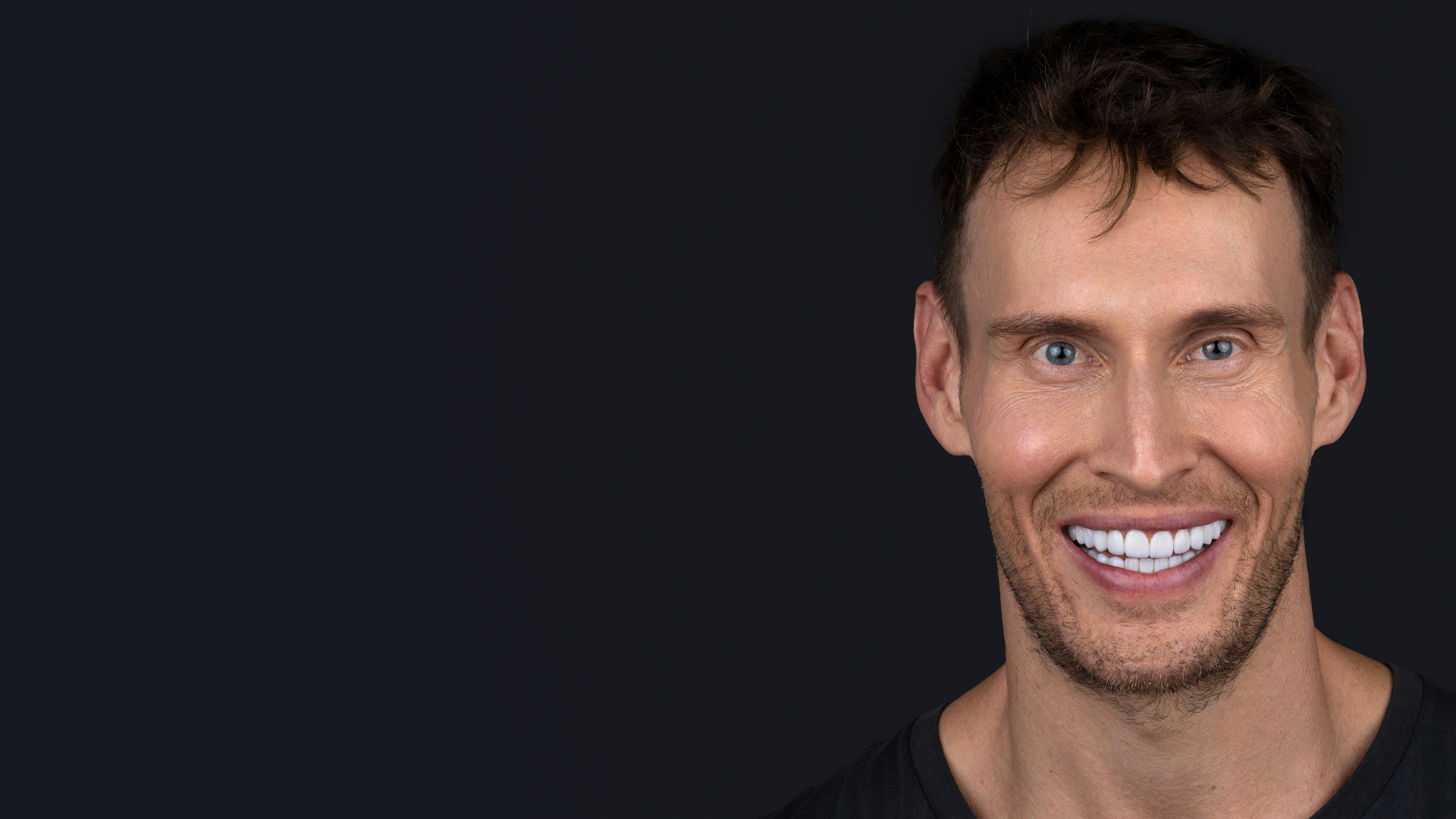 Luke Hines smile makeover with veneers and Invisalign