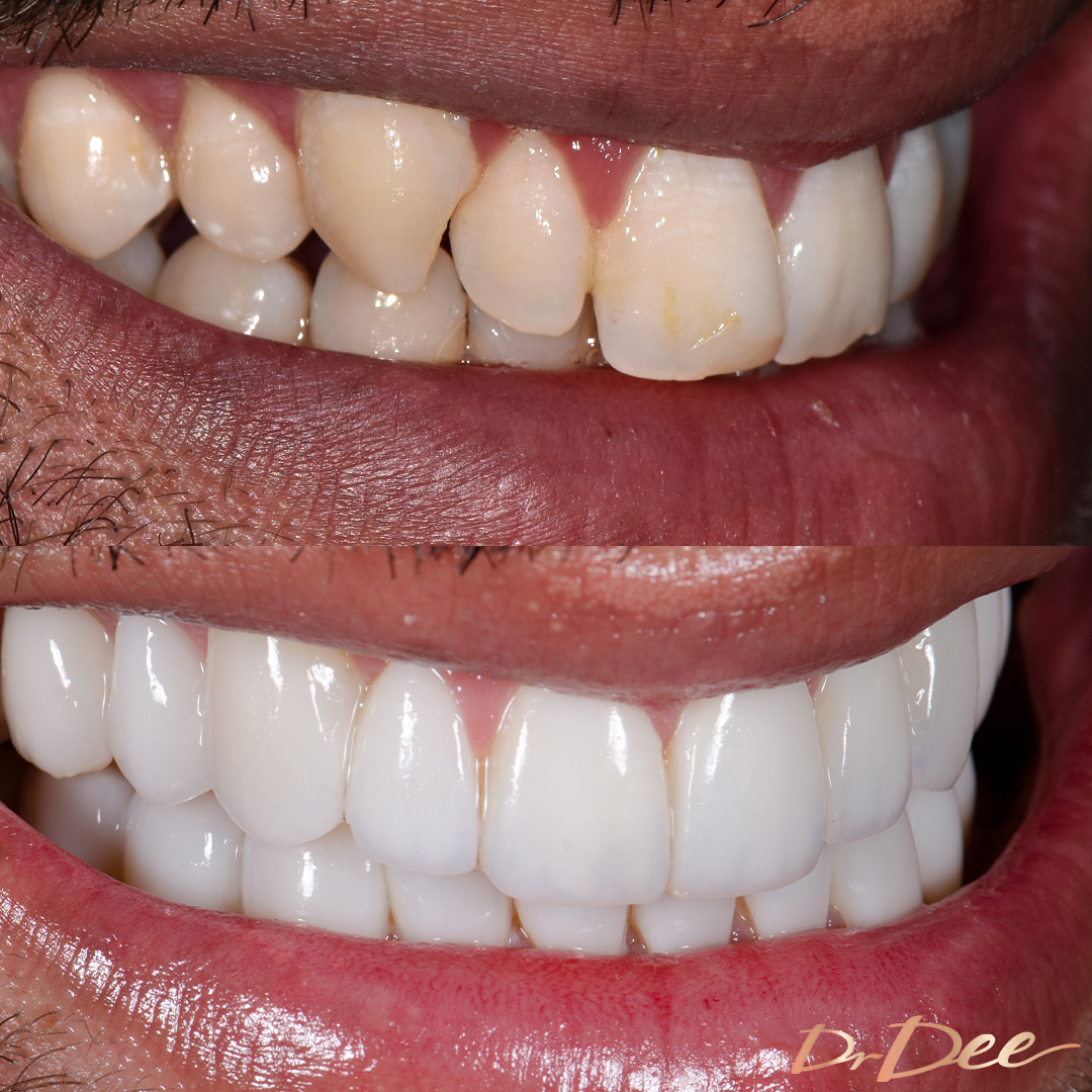 Ibrahim Akbar before and after porcelain veneers right teeth view.
