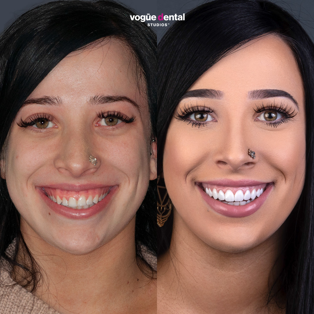 Before and after gummy smile with porcelain veneers at Vogue Dental Studios - font faceview Rachel.