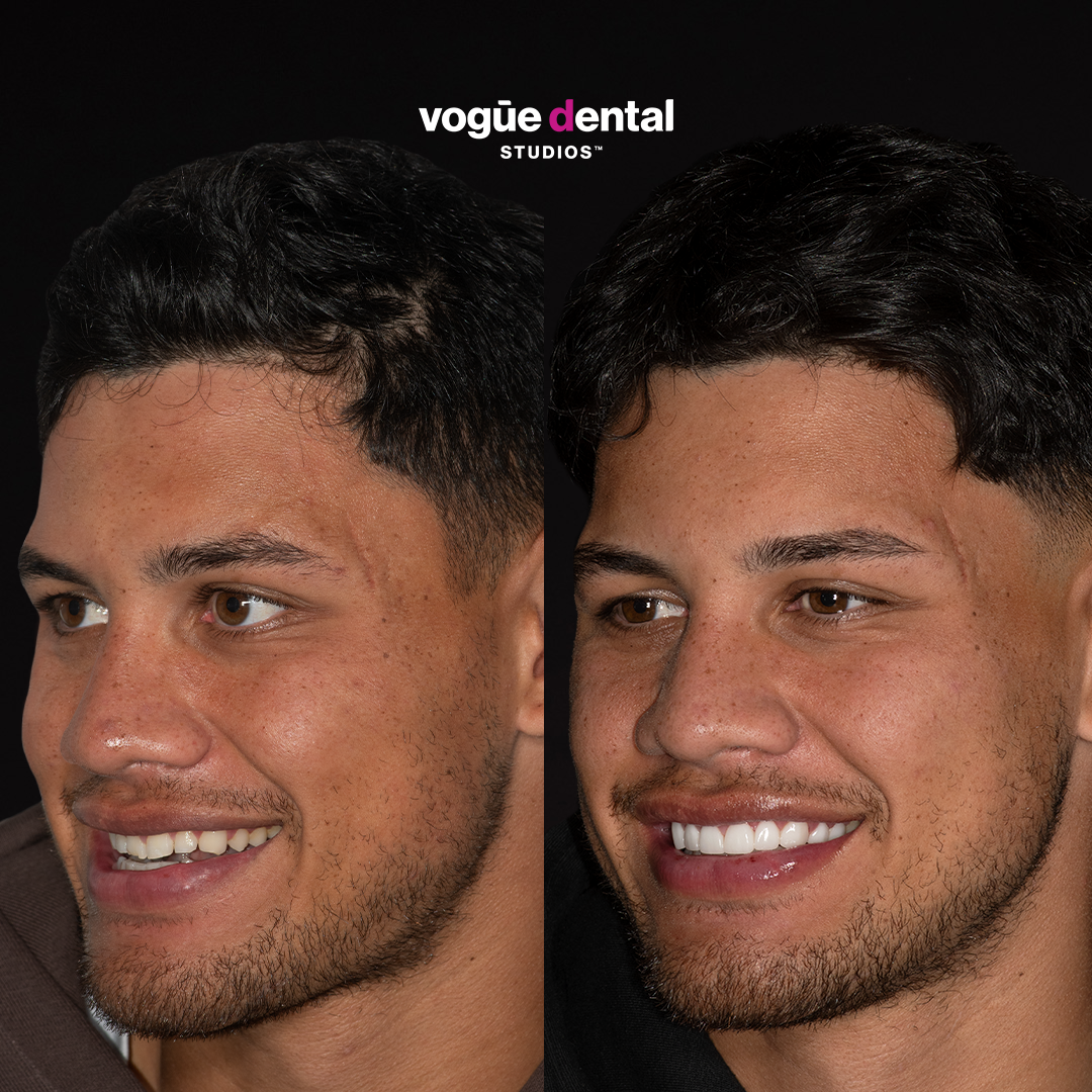 Before and after gappy teeth with porcelain veneers at Vogue Dental Studios - left face view Jaxson