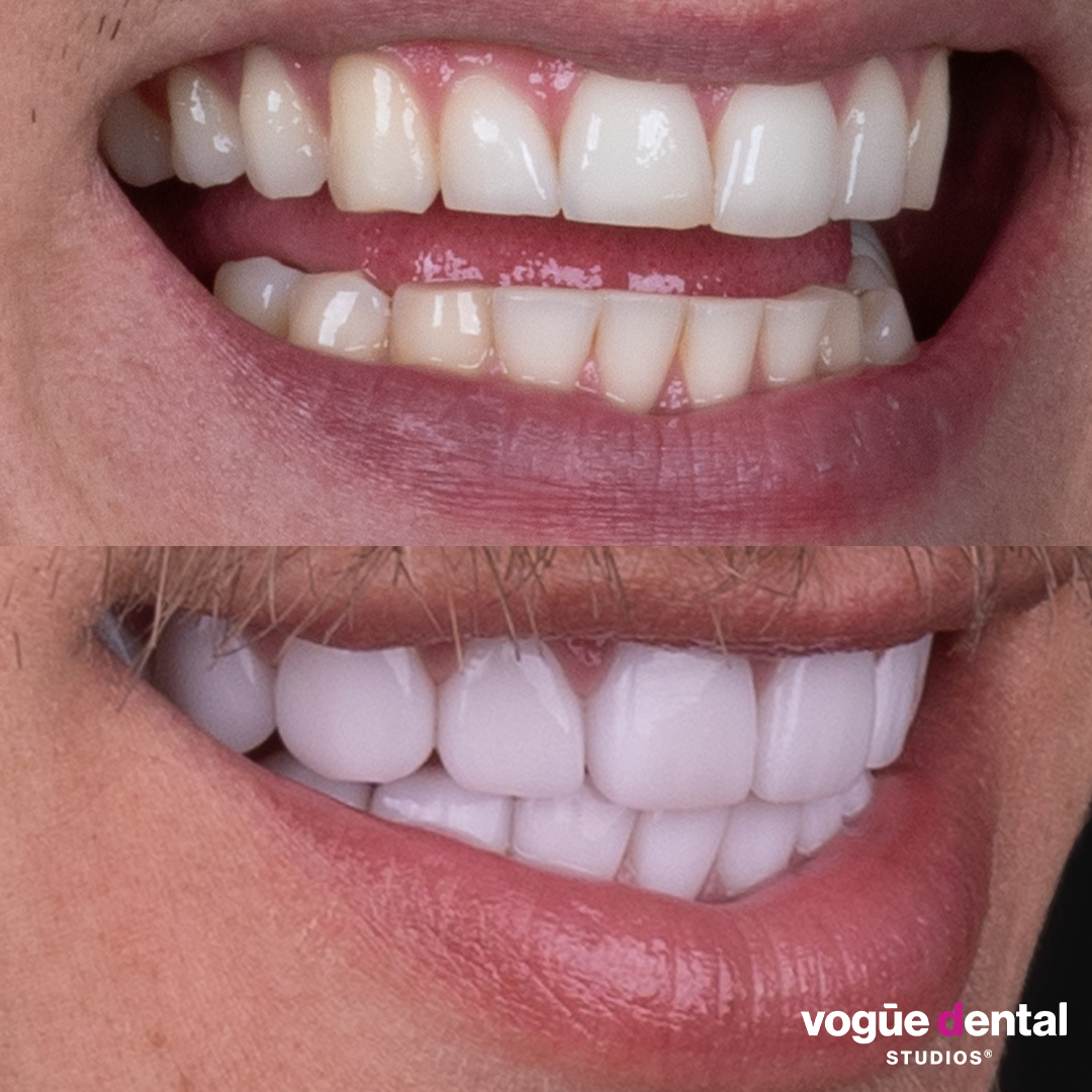 Ciarran Stott before and after smiling with teeth 20 picasso porcelain veneers right view