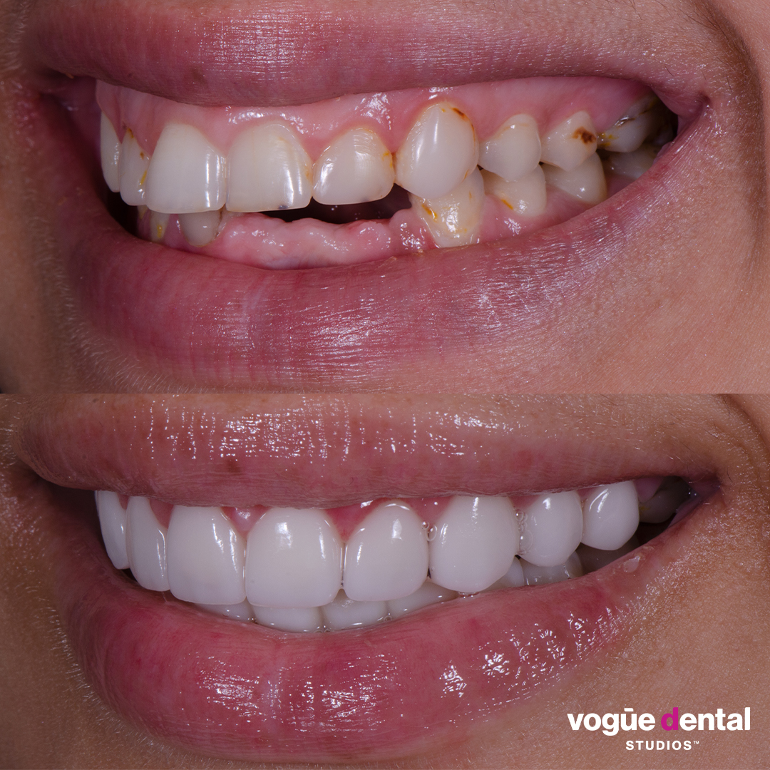 Before and after top and bottom porcelain veneers at Vogue Dental Studios - left teeth view Kara.