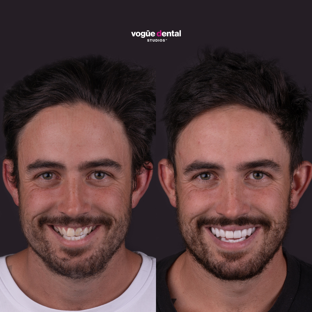 Before and after narrow and chipped smile with porcelain veneers at Vogue Dental Studios - front teeth view Dale.