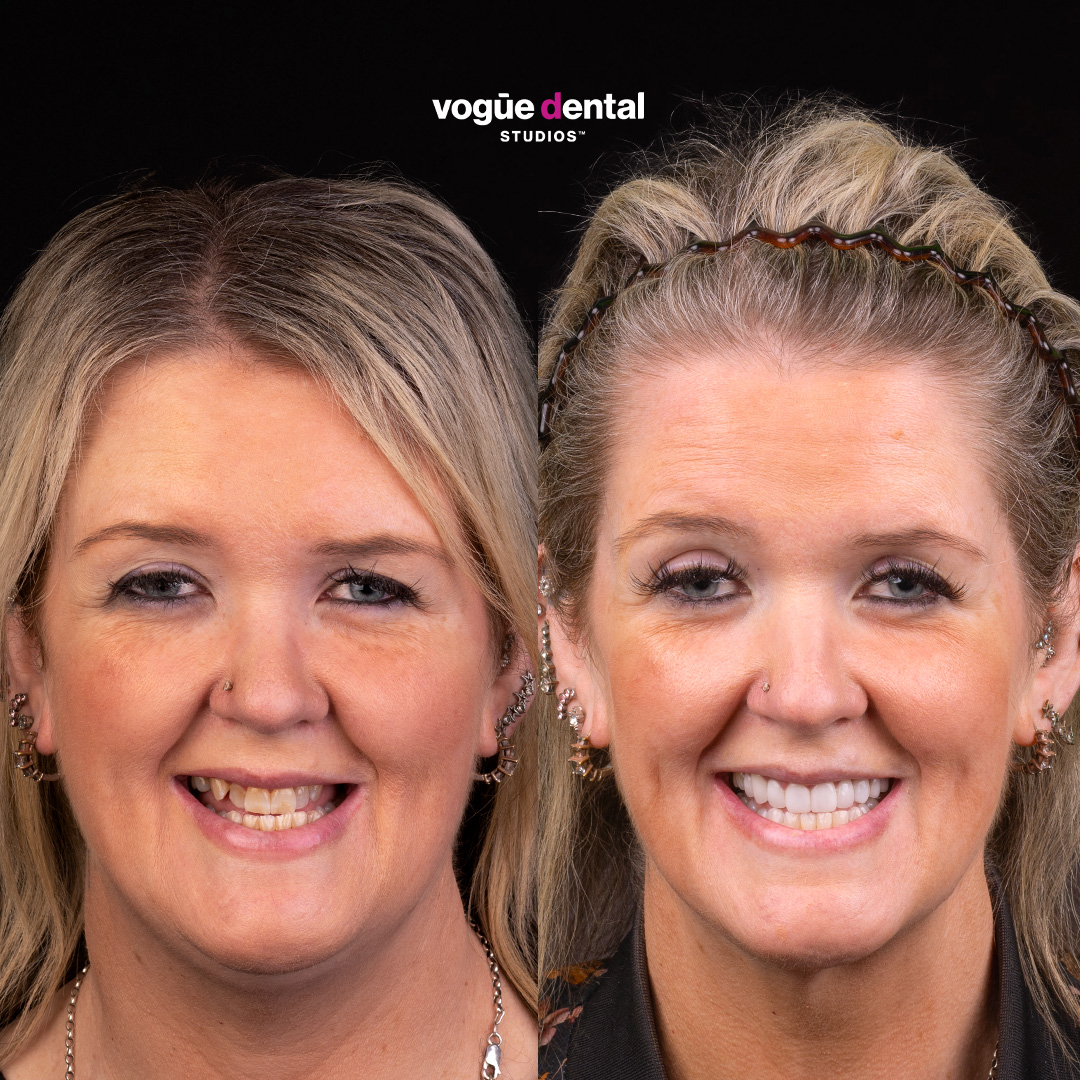 Before and after uneven teeth with upper porcelain veneers by Dr Dee - Lauren