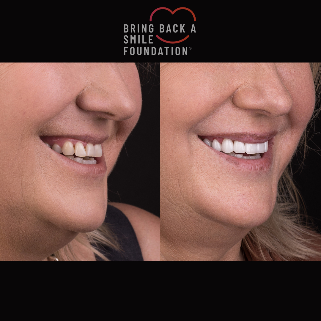 Bring Back a Smile Foundation before and after veneers